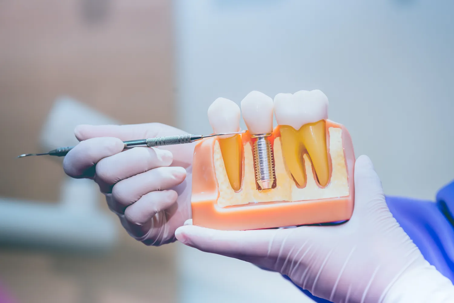 Rodzaje implantów dentystycznych